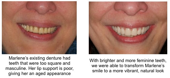 Wax Bite For Dentures San Diego CA 92145